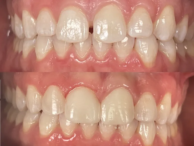 Before and after orthodontic alignment correction at Hutto Hippo Family Dental