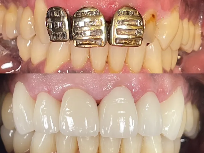 Before and after gold crown replacement with natural porcelain crowns