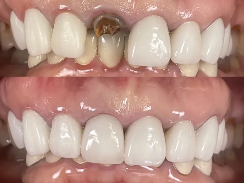 Before and after dental crown restoration for a damaged tooth