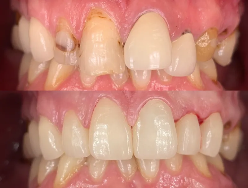 Before and after dental crown and bridge for missing and damaged teeth