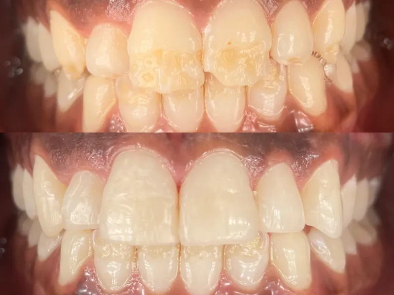Before and after cosmetic dentistry for stained and crowded teeth