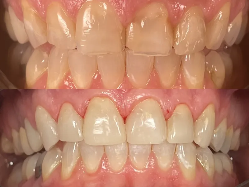 Before and after veneer placement for crooked and worn teeth