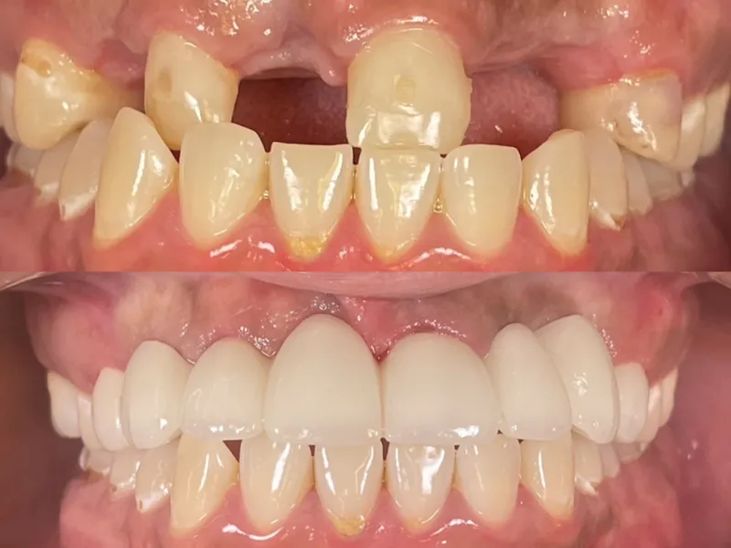 Before and after full mouth restoration with dental implants and bridges
