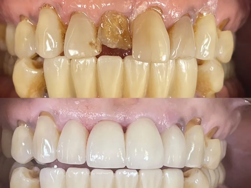 Before and after full mouth rehabilitation with crowns and bridges
