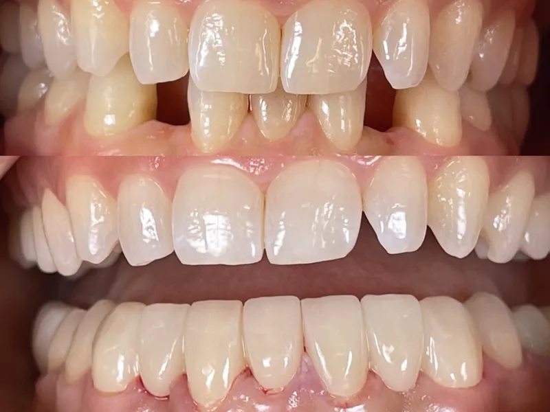 Before and after gap closure with porcelain veneers