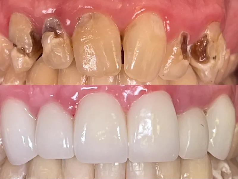 Before and after full smile restoration for decayed and damaged teeth