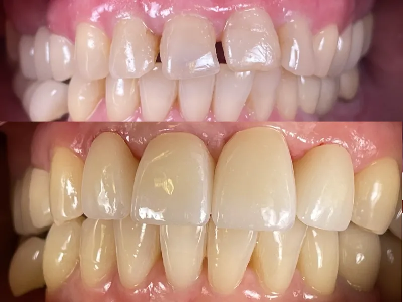 Before and after dental bridge and veneers for spacing and alignment