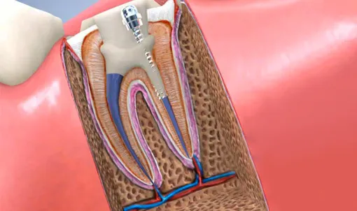 Cover for Root Canal: Pain Before and After