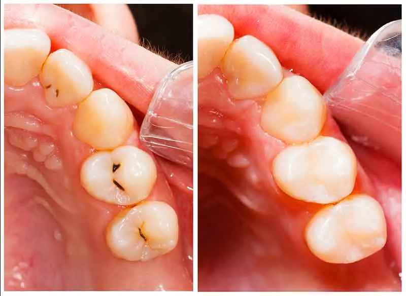 Cover for Antibacterial Fillings to Fight Cavities