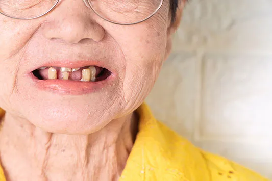 Cover for Tooth Loss Connected with Dementia