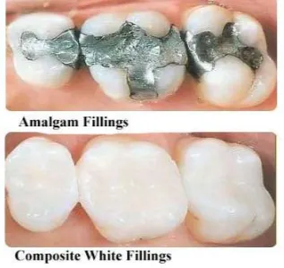 Cover for Should You Get Rid of Your Metal Fillings?