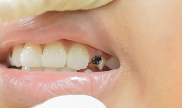 Cover for Black Teeth: Causes and Treatment Options