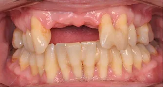 Cover for What Causes Tooth Loss?