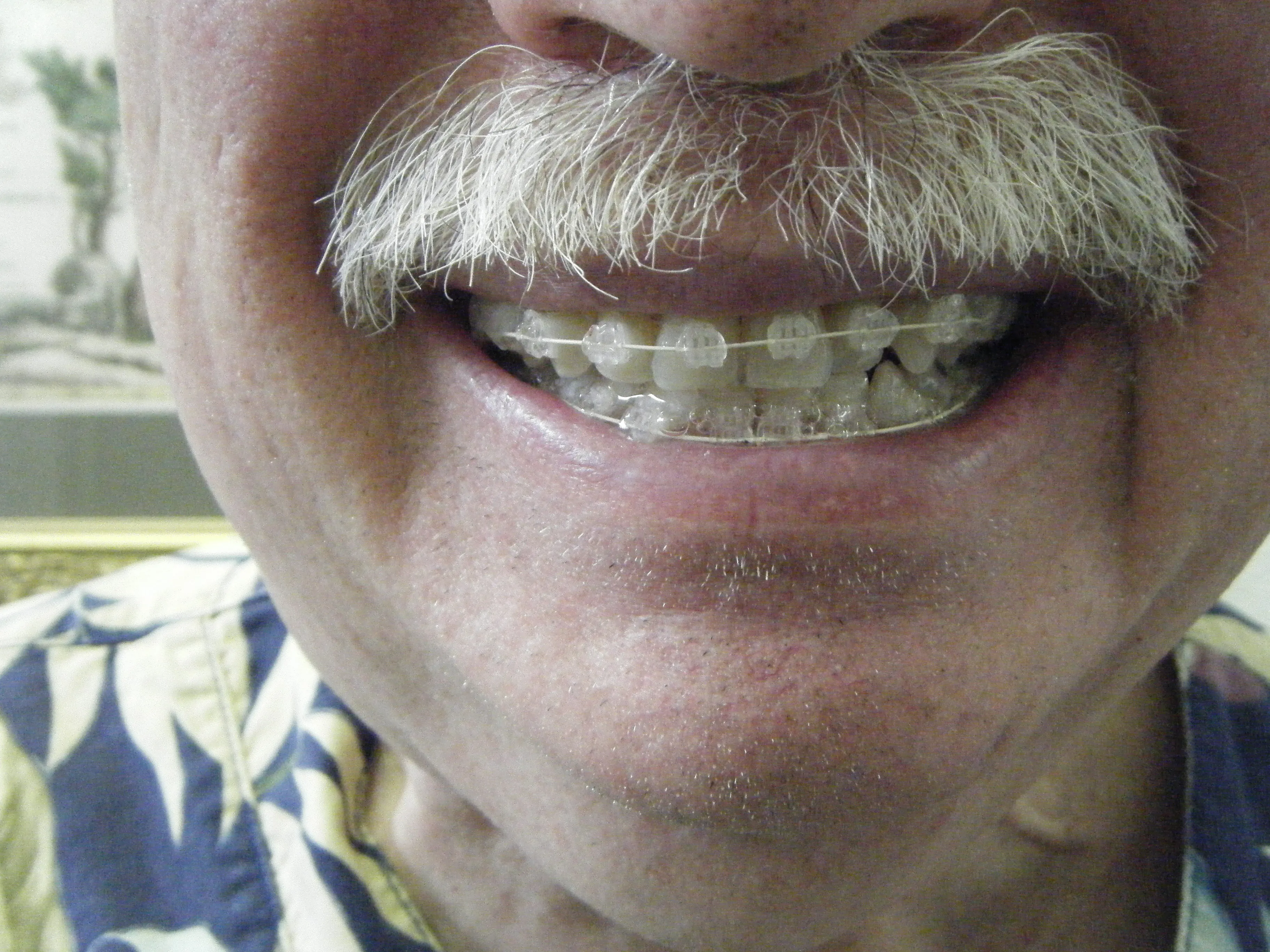 Cover for Are Braces Just for Kids or Can Adults Get Braces?
