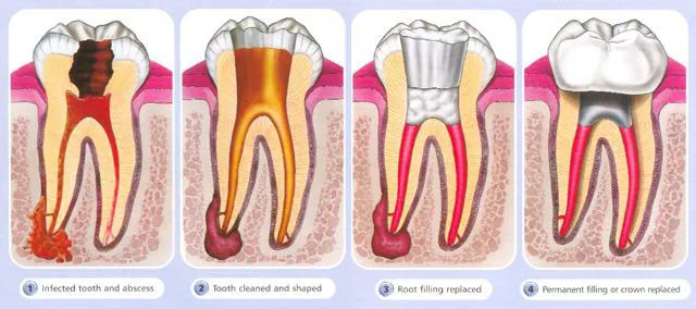 Cover for Root Canal Horror Stories