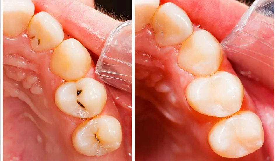 Cover for Make Resin Fillings Last Longer