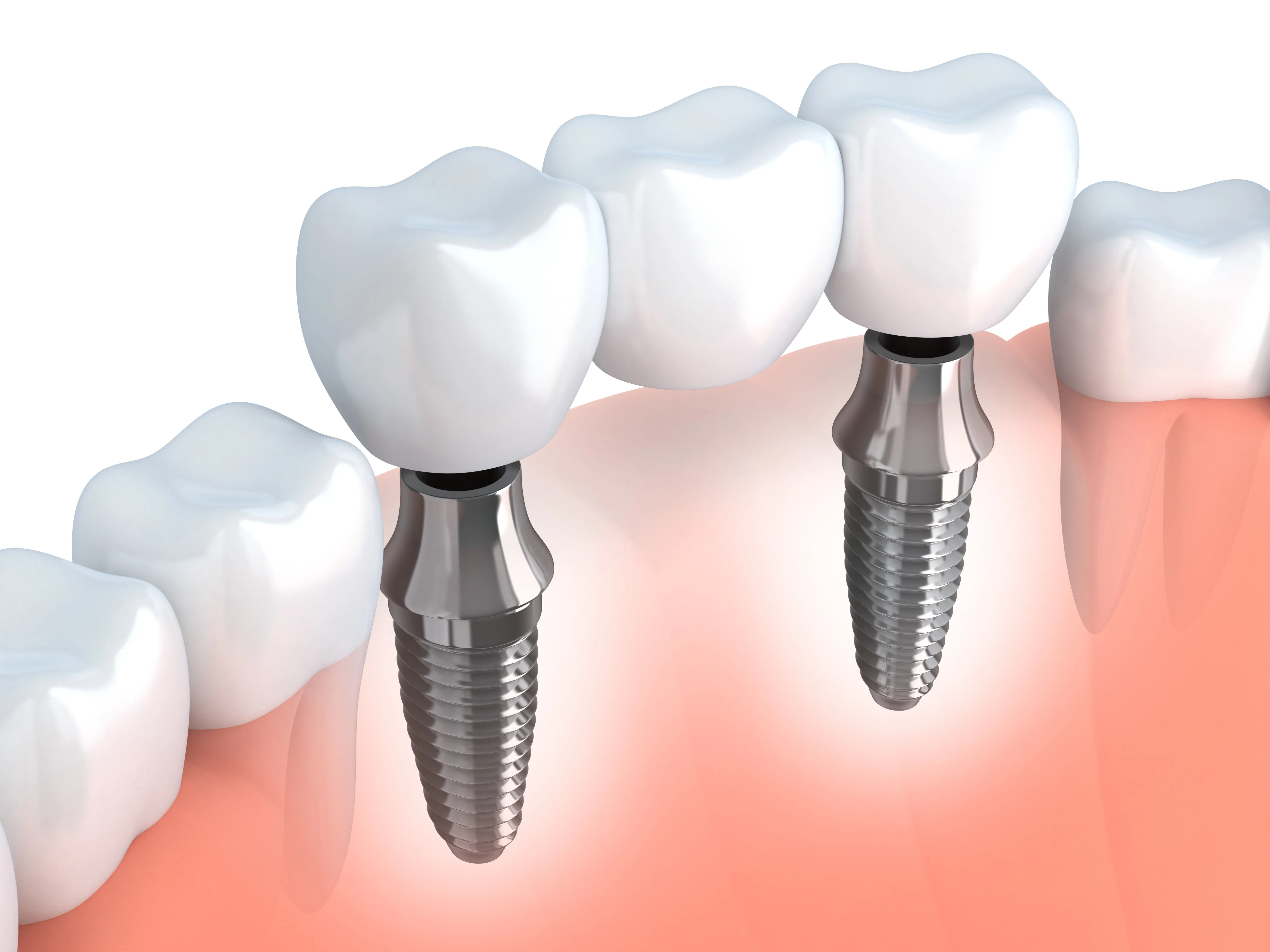 Cover for What Are the Advantages of Dental Implants?