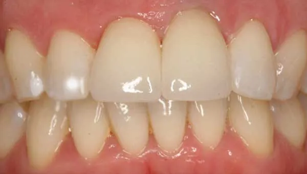 Cover for White Spots on Teeth: Causes and Treatments