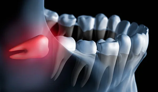 Cover for Wisdom Tooth Extraction and Soft Food Diets