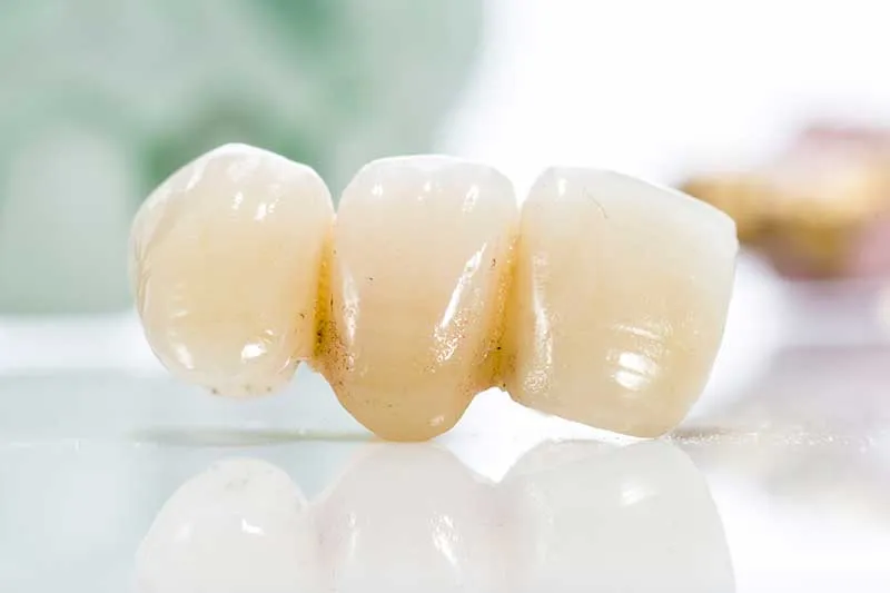Cover for Loose dental crown—is it an urgent matter?