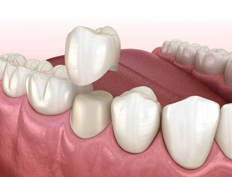 Cover for What CEREC Is and How It Works