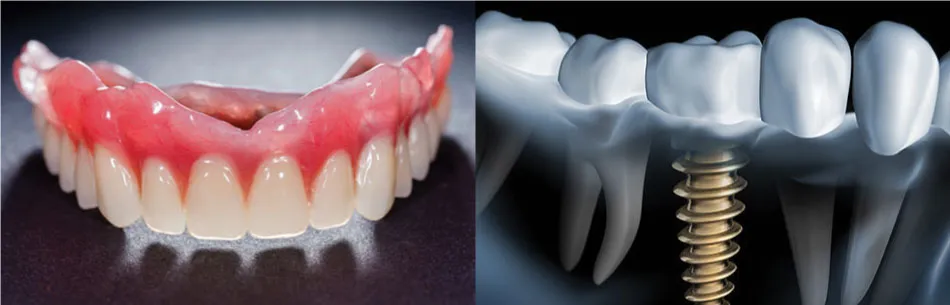 Cover for Dentures or Dental Implants: Which to Choose?