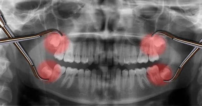 Cover for Wisdom Teeth Extraction Improved the Ability to Taste