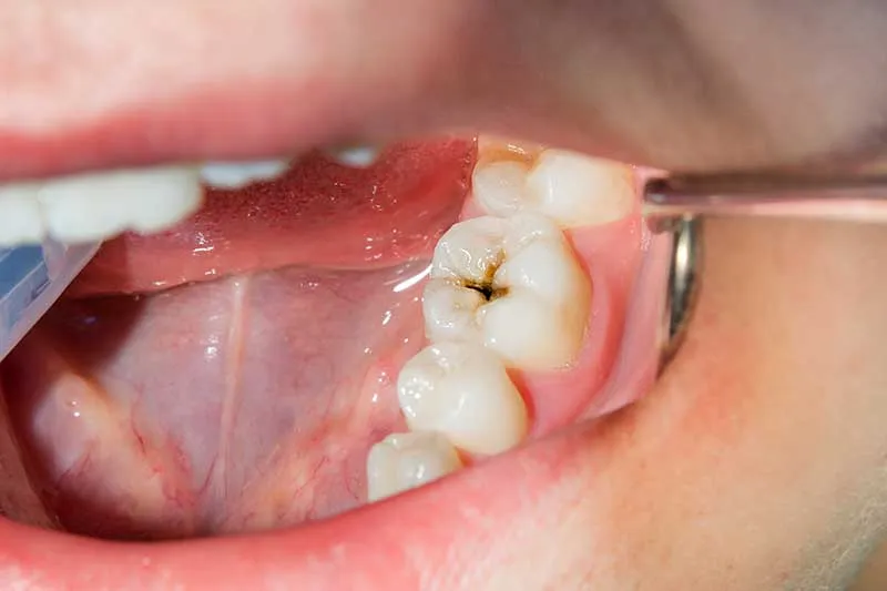 Cover for What Are Cavities and Why Treat Them?