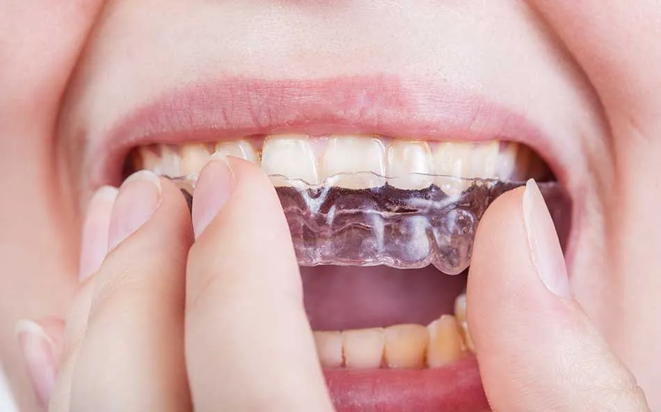 Cover for Is Cleaning Retainers Important to Do?