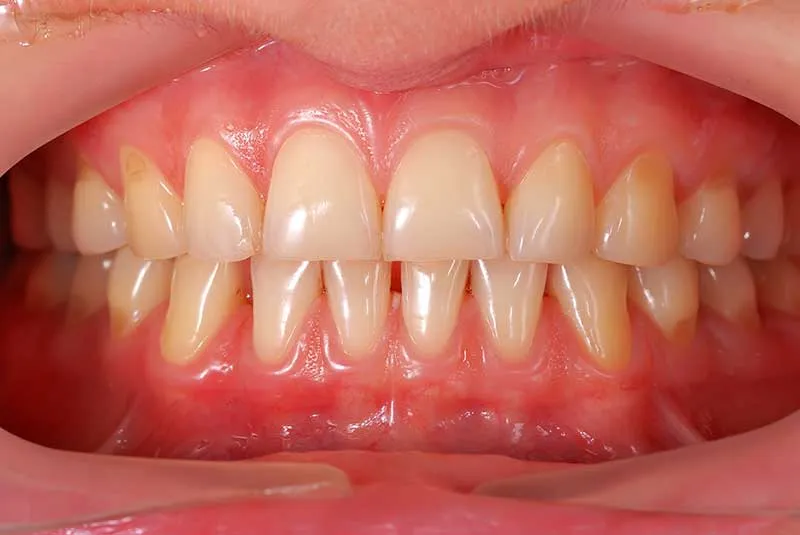 Cover for Gum Lift: What Is It and Why Get One Done?