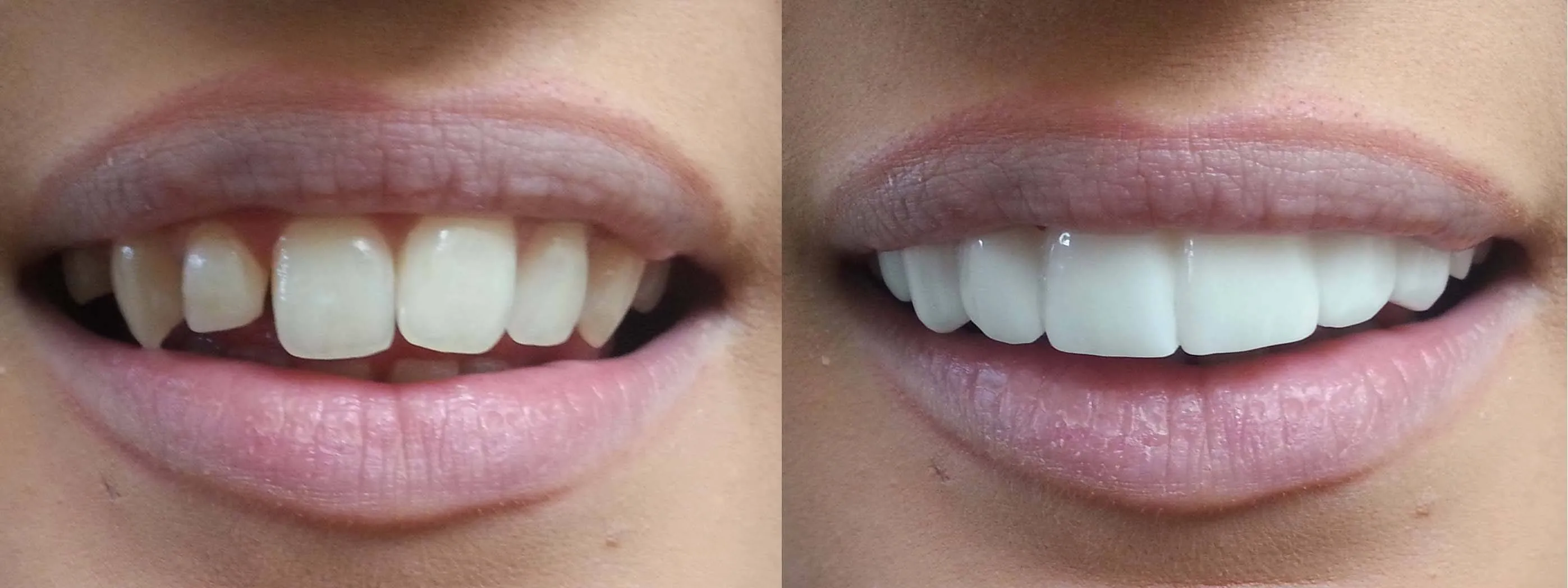 Cover for Veneers: What’s in a Beautiful Smile?