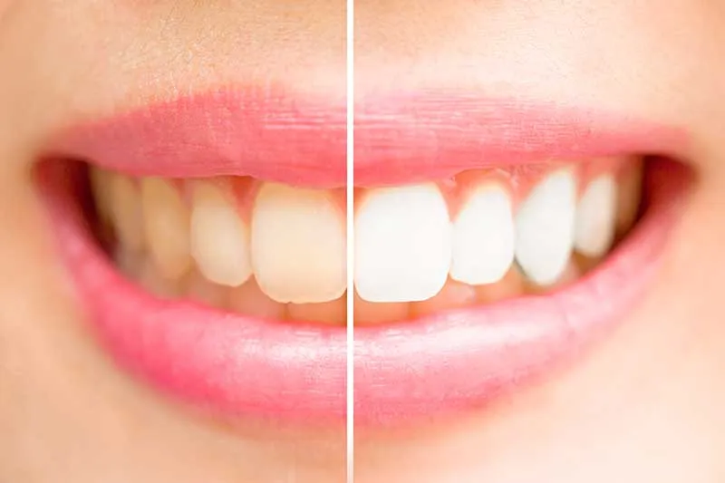 Cover for Whiter Teeth: Is It a Myth that They Are Healthier?