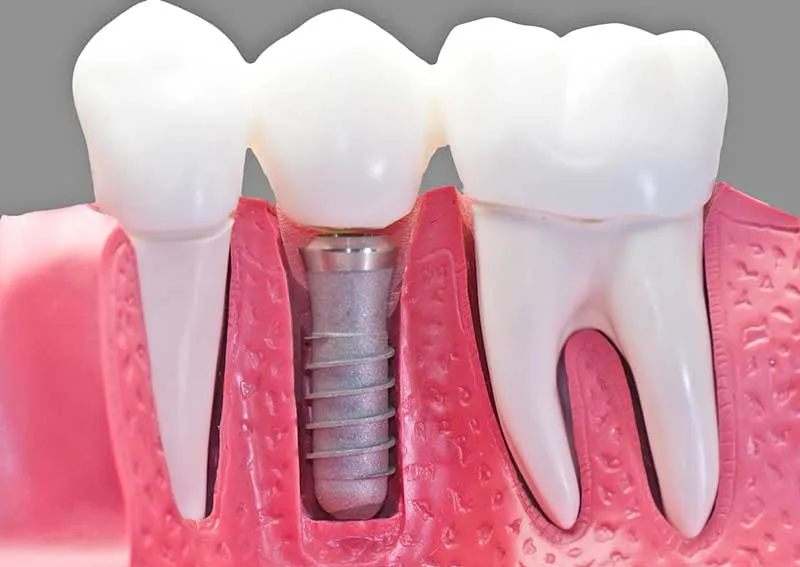Cover for Questions about Dental Implants  (FAQs)