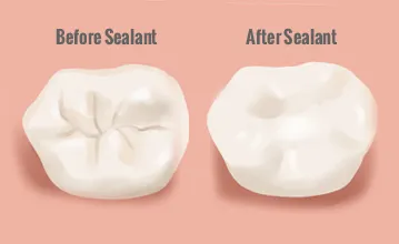 Cover for What is a sealant and when do dentists use them?