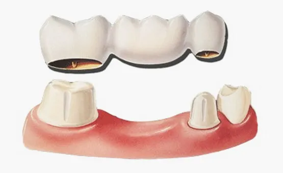 Cover for Dental Bridge: How It Works and the Advantages It Offers