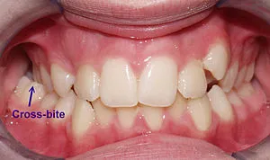 Cover for What Is Crossbite and How Do Dentists Correct It?