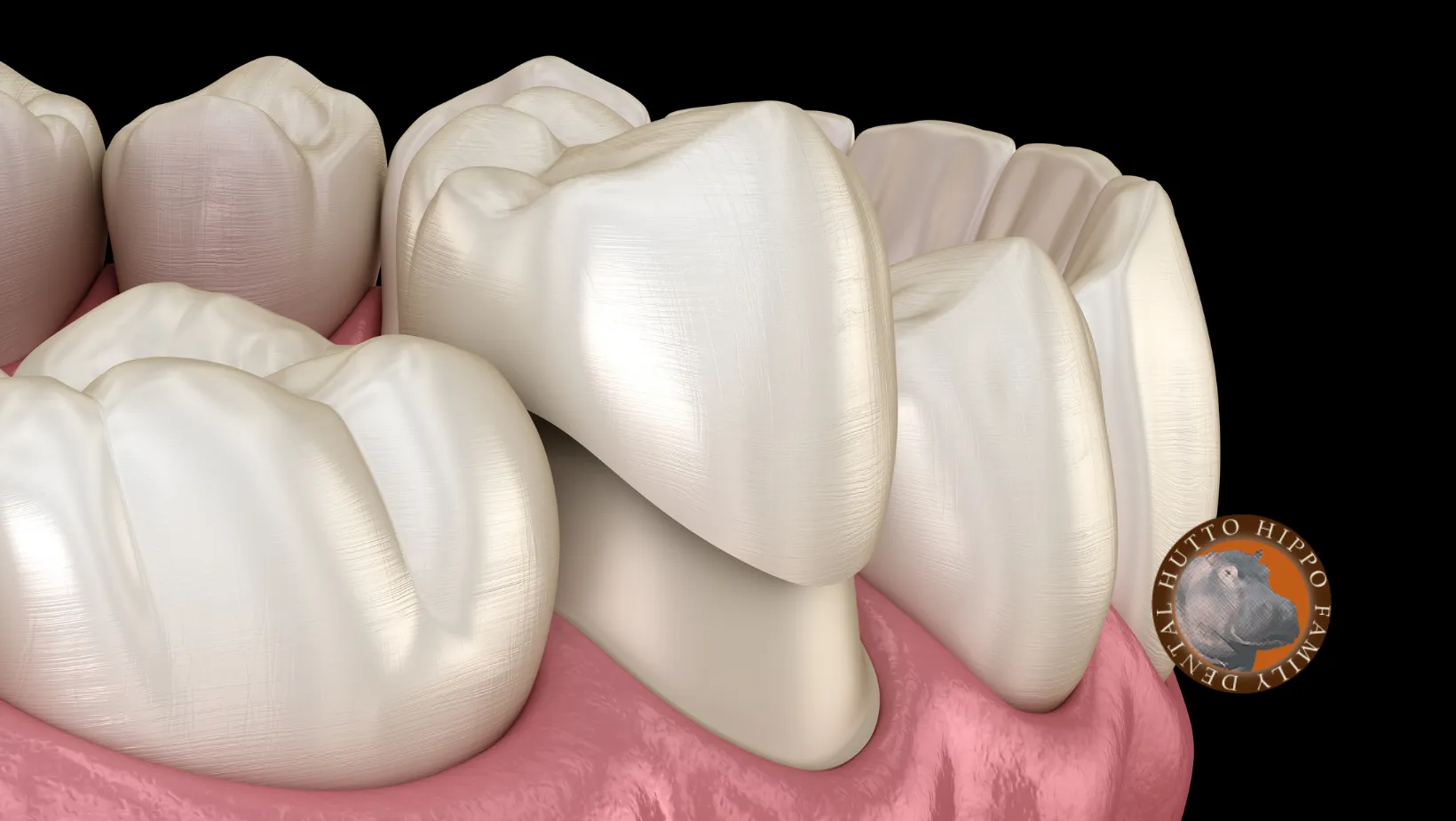 Cover for Dental Crowns or Dental Caps
