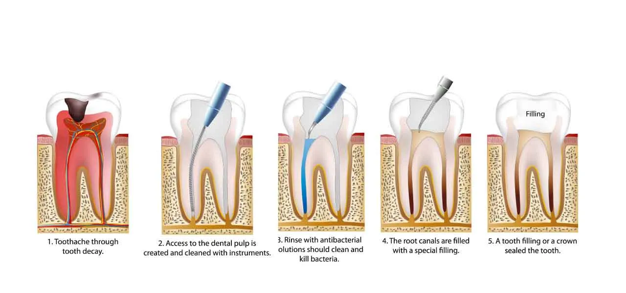 Cover for How Long Do Teeth with Root Canals Last?