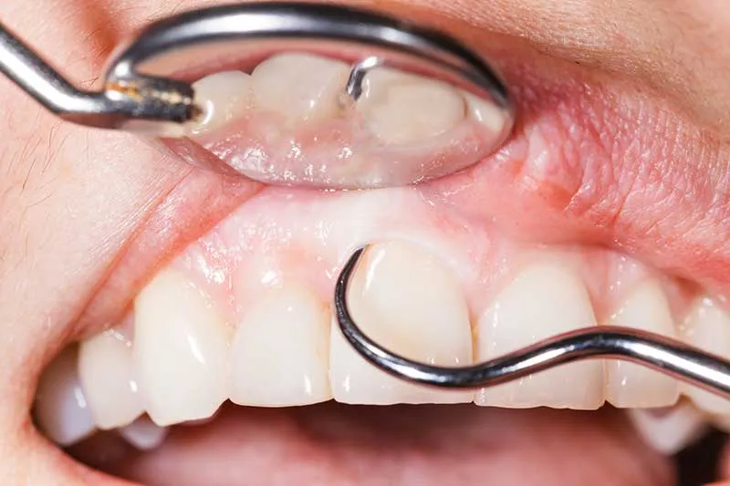 Cover for Gum Disease and High Blood Pressure