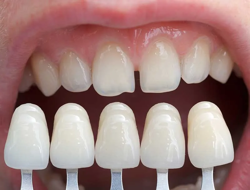 Cover for Good Oral Hygiene for Dental Veneers