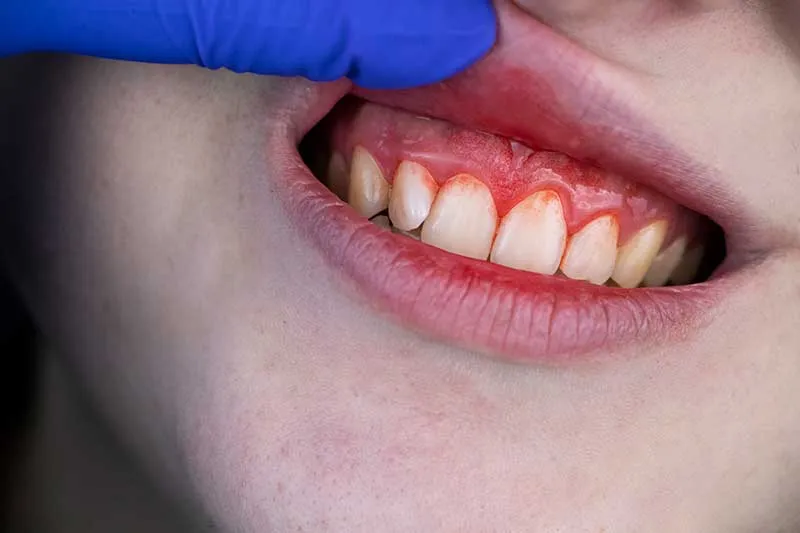 Cover for Obesity Can Lead to Gum Disease
