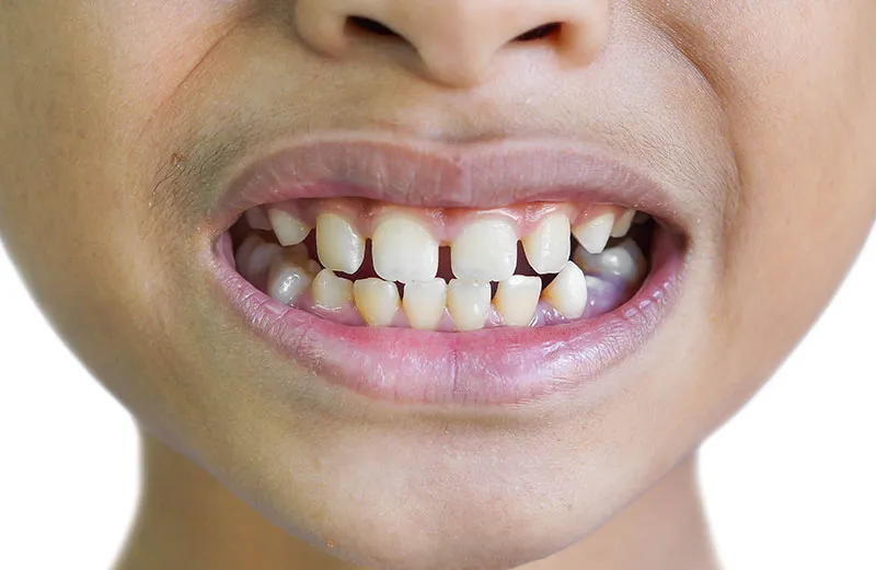 Cover for Should You Be Concerned About Gaps Between Teeth?
