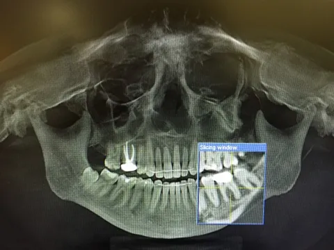 Cover for What Are Digital X-rays and Their Benefits?