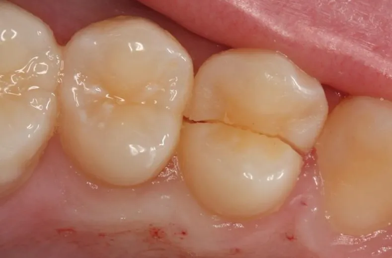 Cover for What Are Cracked Teeth and How and When Are They Treated?