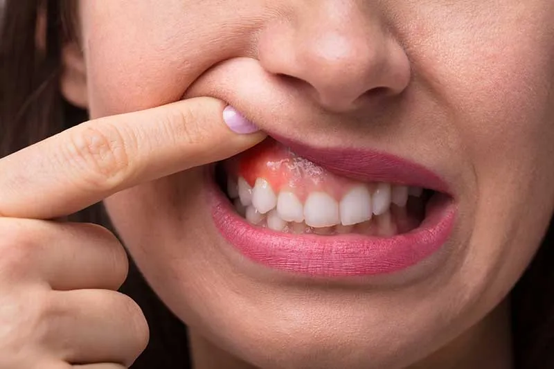 Cover for Causes and Treatment for Swollen Gums