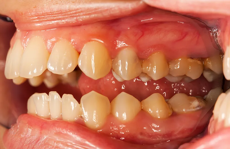Cover for A Probiotic to Prevent Tooth Decay