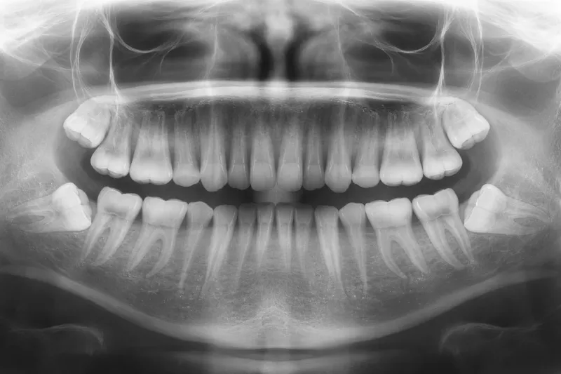 Wisdom teeth extraction